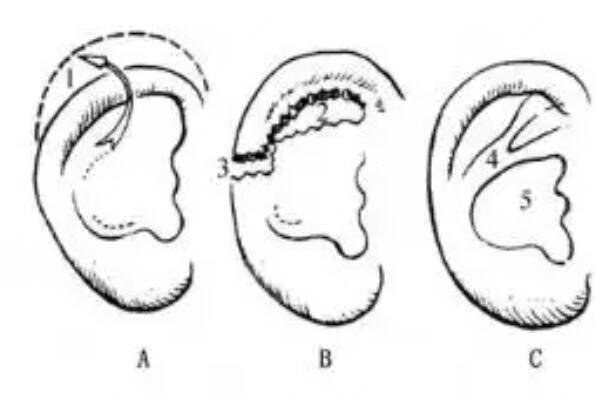 杯状耳整形手术效果怎么样