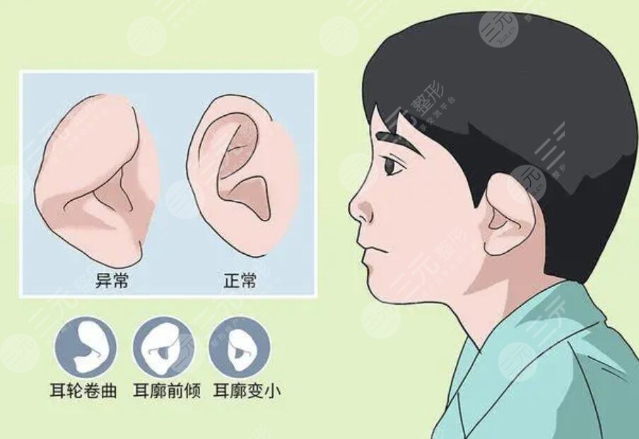 杯状耳整形多少钱呢,可以手术吗?手术注意事项有哪些?优质科普回答看这篇就行了~