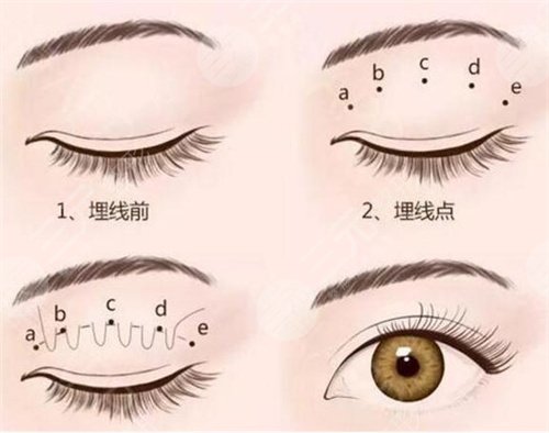 刘辉医生做双眼皮手术案例