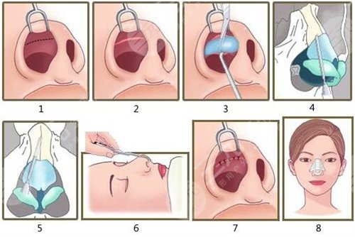 佳木斯二院隆鼻图前