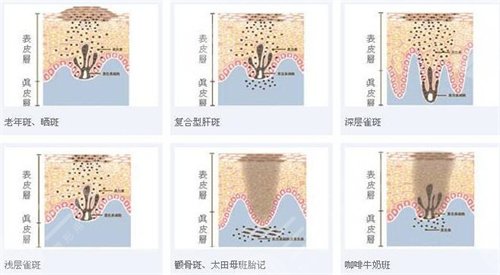 激光祛斑案例