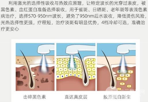 昆明云大医院激光祛斑科普