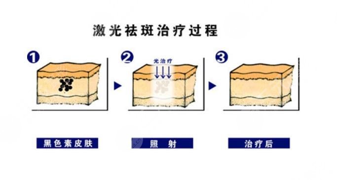 激光去斑一般多少钱?