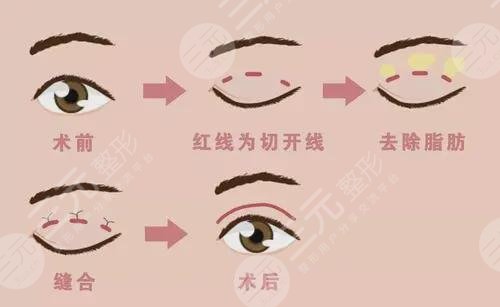 遗传性单眼皮如何变双眼皮?