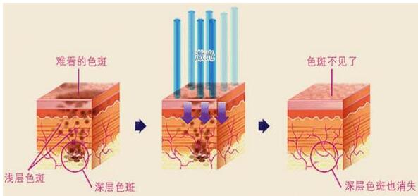 广州南方医院点阵激光治疗大概多少钱?