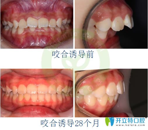 成都青苗口腔深覆盖矫正后脸型变化图