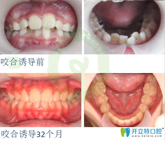 儿童牙齿拥挤矫正前后对比照