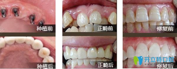 德韩口腔种植牙及正畸修复效果案例