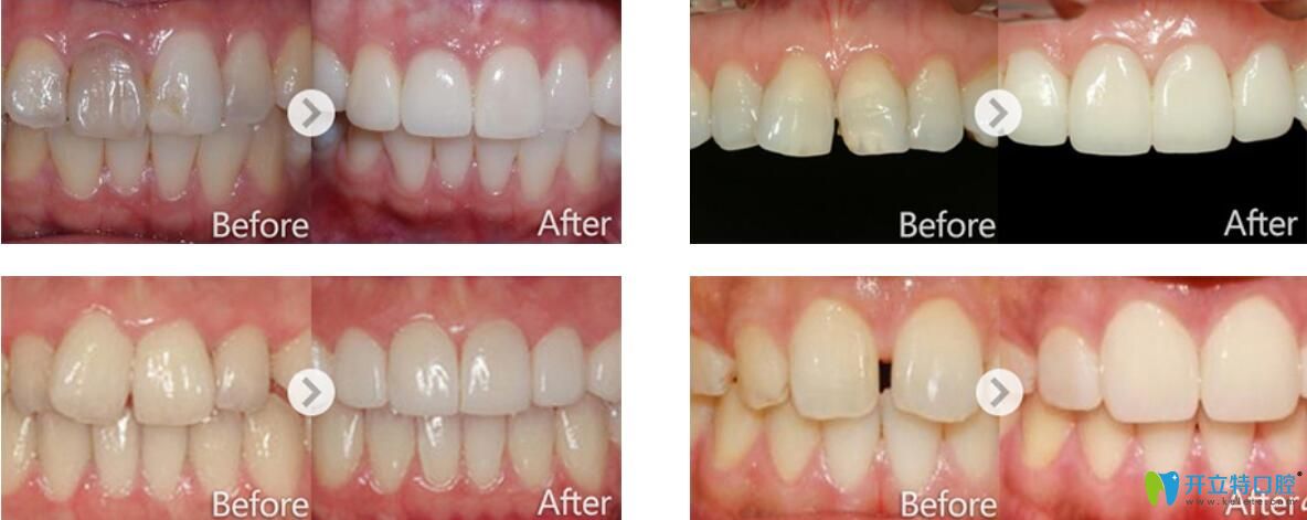 武汉爱思特口腔怎么样，好不好？牙贴面修复案例效果来证明