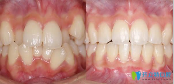 大连博大口腔牙齿矫正案例效果对比图