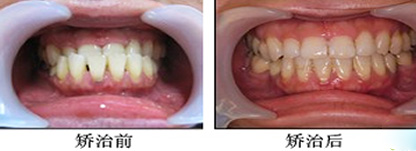 宁波拜博拜尔牙齿畸形矫正效果图