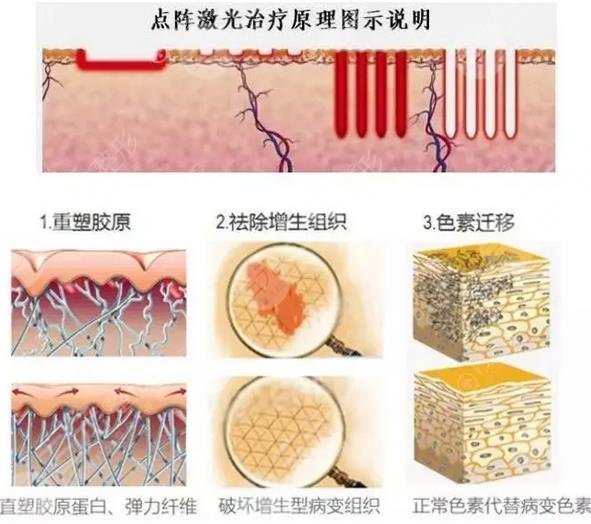 点阵激光