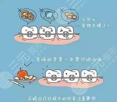 牙齿矫正饮食注意事项