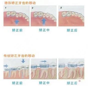 牙齿矫正原理