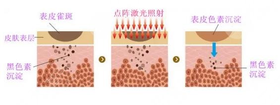 点阵激光原理