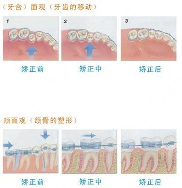 佩戴牙套需要注意的事项