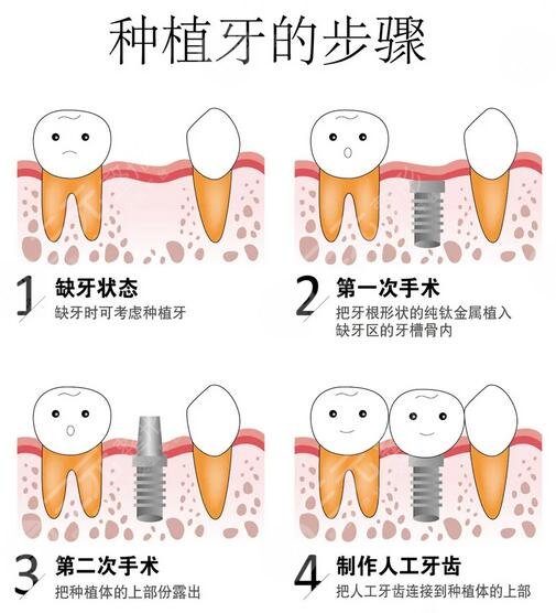 广州华侨医院正畸收费高吗