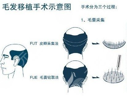 深圳市人民医院植发案例效果图