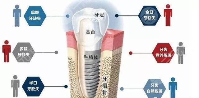 牙齿种植特点