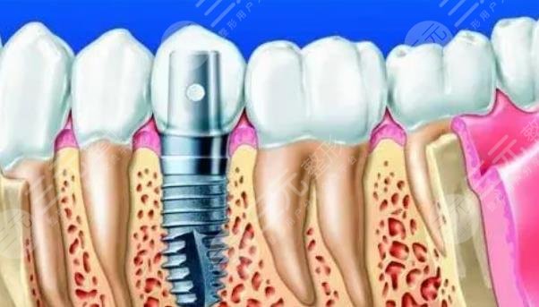 北大深圳医院种植牙案例