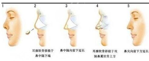 上海仁爱医院隆鼻案例