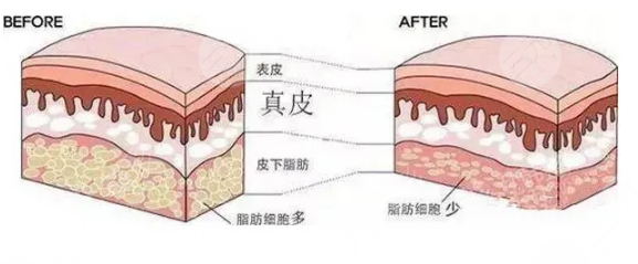 抽脂手术都有哪些危害?