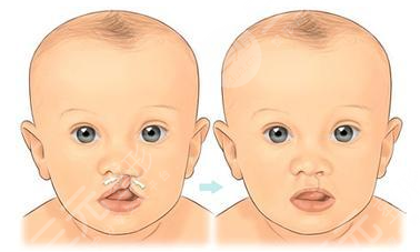 唇腭裂修复手术大概需要多少费用？价格表|兔唇矫正手术实际案例果