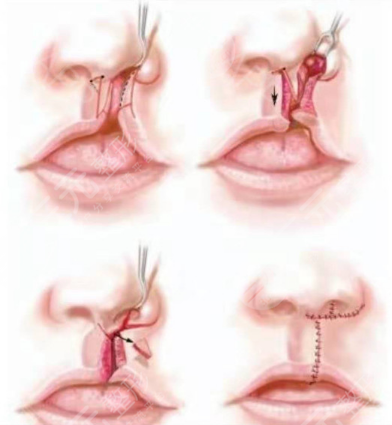 唇腭裂修复手术的原理