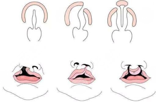 腭裂修复手术后的护理事项