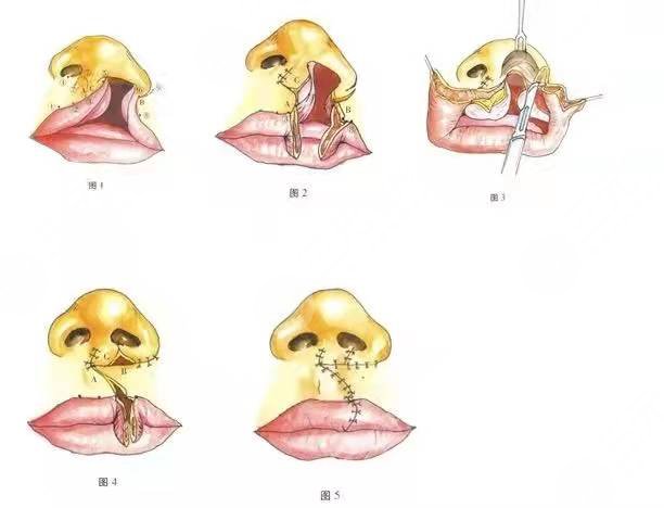 唇腭裂兔唇矫正手术术后半个月