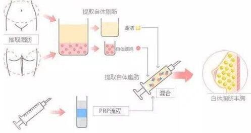 自体脂肪隆胸的原理是什么