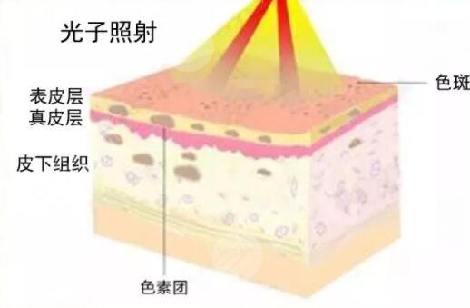 光子嫩肤的原理