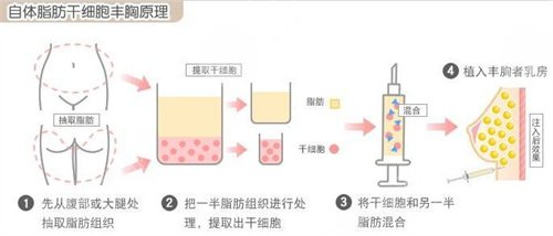 玻尿酸填充前