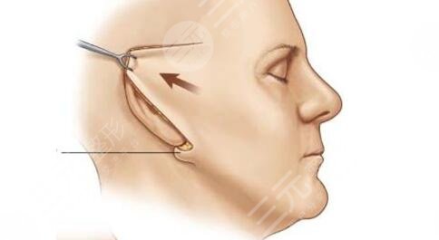 拉皮手术的原理