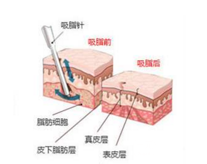 大腿吸脂多少钱