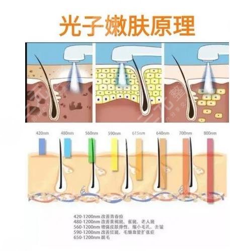 光子嫩肤的作用原理主要是针对皮肤组织细胞,通过利用光子中含有的高