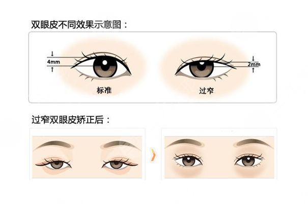 2024兰大二院做双眼皮价目表来袭！一起来看下具体情况吧