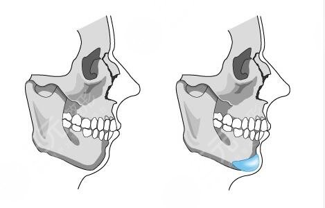 假体垫下巴术后注意事项