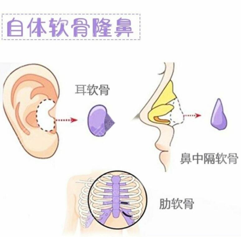 隆鼻手术材料汇总