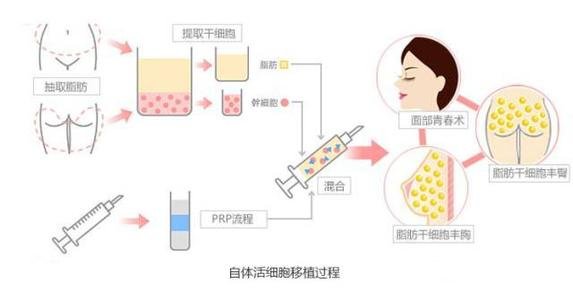 西京医院自体脂肪填充隆胸丰胸多少钱