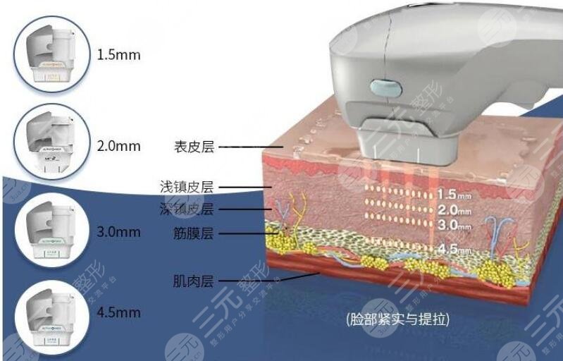 激光除皱