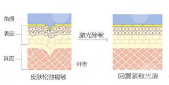 激光除皱的特点