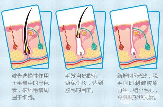 浙二医院整形美容科脱毛技术好不好