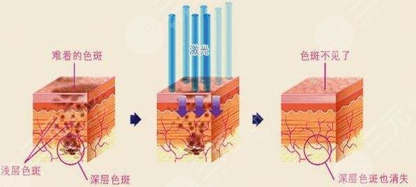 去黄褐斑案例