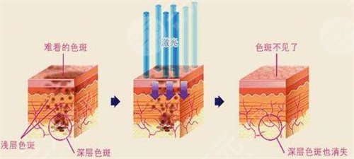 哈医大二院祛痣果图