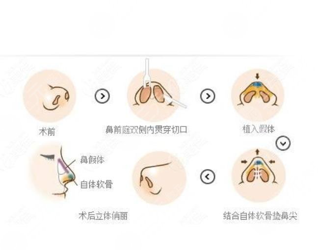 隆鼻失败修复步骤是怎样的?