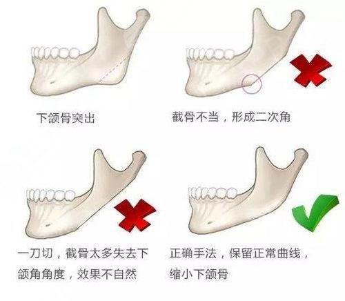 磨骨手术风险高吗图片