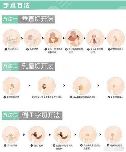 乳房手术消毒范围图片图片