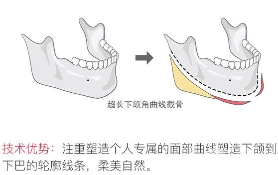 下颌角手术