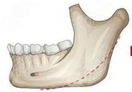 下颌角截骨术案例对比图 下颌角整形后多久恢复